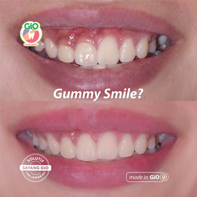 gio-gingivectomy